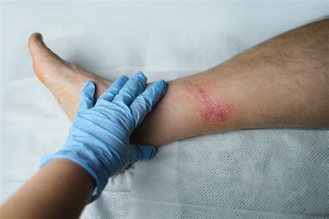 How to tell if a wound is healing or infected | OSF HealthCare