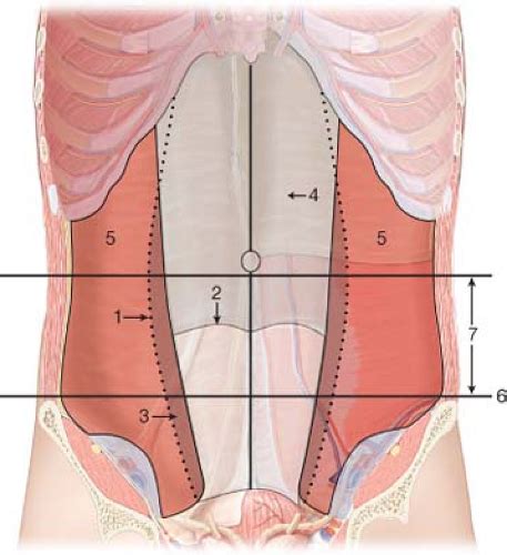 Collection 104+ Images Pictures Of Hernias In The Stomach Stunning