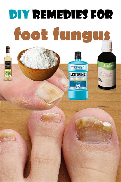 DIY remedies for foot fungus | HEALTHYLIFE