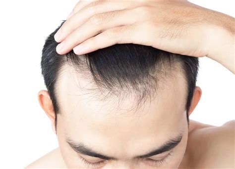 Hair Thinning at The Front: Why & What to Do