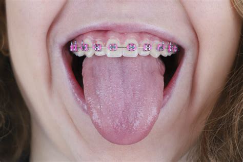 Are Rubber Bands on Braces Important? | Ft Collins CO Orthodontist