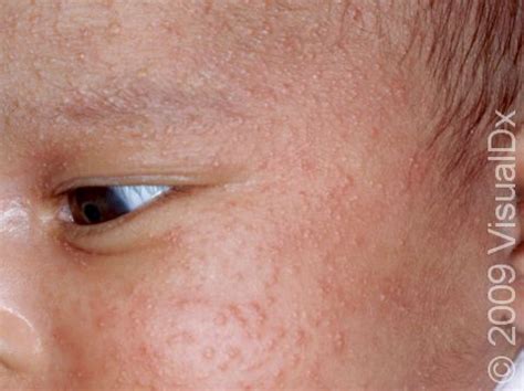 Neonatal Acne: Causes, Symptoms, and Treatment