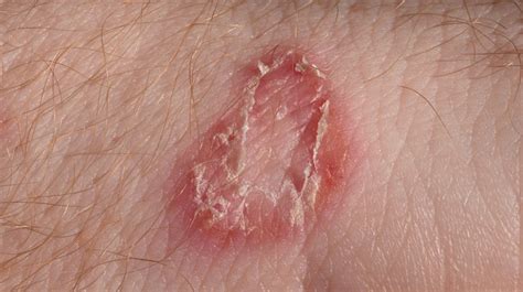 Itching (Pruritis): Pictures, Causes, Remedies, and More