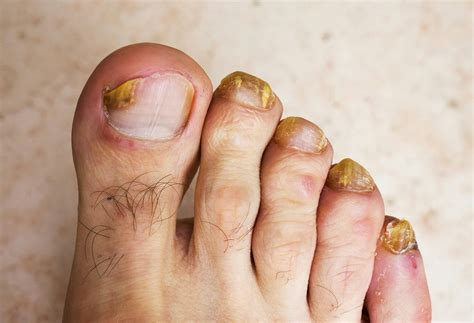 how to get rid of toenail fungus for good - Toenail Fungus Treatment ...