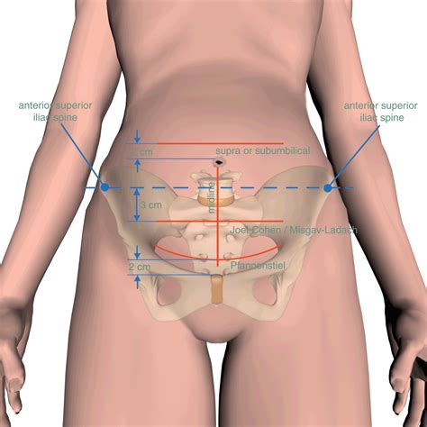 Cesarean Section Technique With Diagram