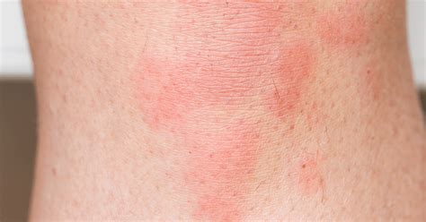 Can Stress Cause Hives? Photos And Explanation