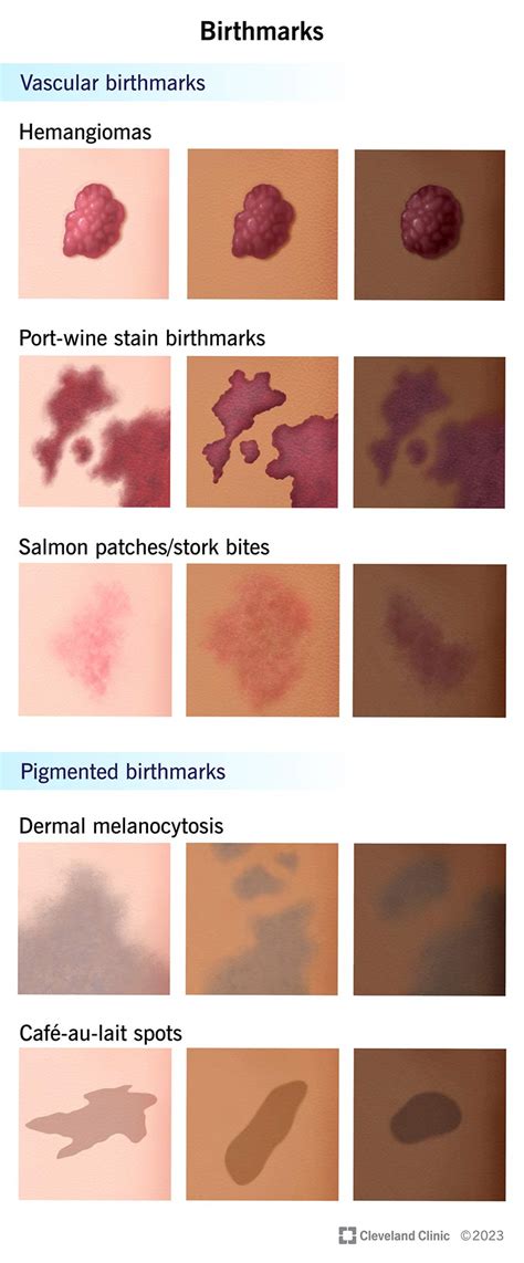 Birthmark Causes & Treatments