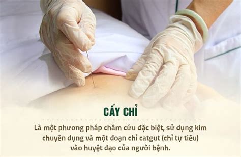 Cấy Chỉ Giảm Béo Là Gì? Có Hiệu Quả Không? Góc Giải đáp