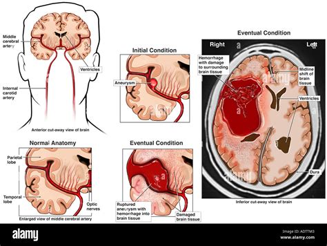 Rupture of Cerebral Aneurysm Stock Photo - Alamy