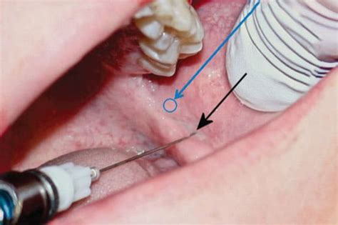 Combined Inferior Alveolar Nerve Block Anaesthesia And, 50% OFF