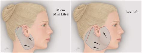 Micro-Mini Lift®: Shorter Recovery Time Than a Facelift