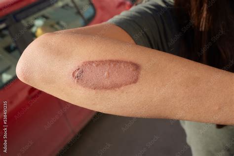 Cut wound on arm and a chemical burn from hydrogen peroxide. Close up ...