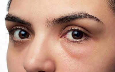 What Causes Puffiness Under the Eyes? - VIDA Wellness and Beauty