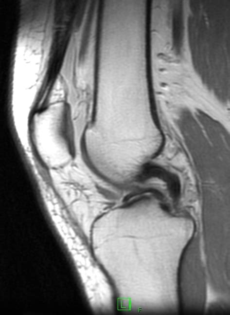 Bucket Handle Meniscal Tear-MRI - Sumer's Radiology Blog