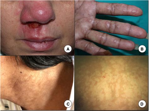 Cutaneous and Mucocutaneous Leishmaniasis | Actas Dermo-Sifiliográficas