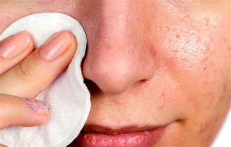 Infected Blackheads - Pictures, Symptoms, Causes, Treatment