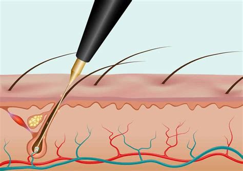 Electrolysis vs Laser Hair Removal – What Are the Differences? – Headcurve