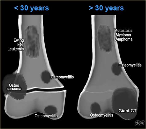 osteosarcoma x ray sunburst - Google-søk | radiology | Pinterest | Radiology