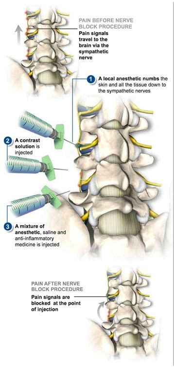 Lumbar Sympathetic Block - The Southeastern Spine Institute