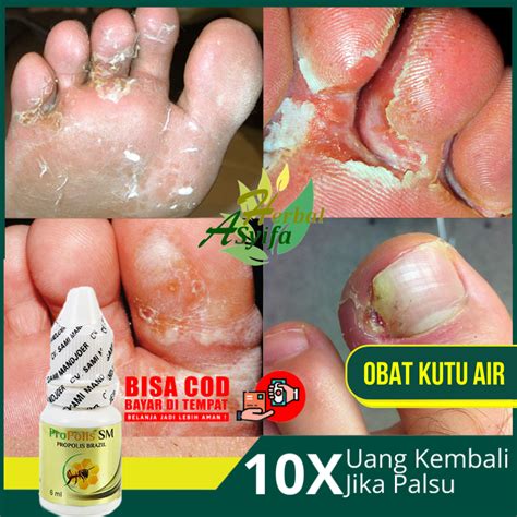 Obat Kutu Air - Obat Untuk Kutu Air, Penghilang Kuman Air, Jamur Kutu Air, Menghilangkan Kutu ...