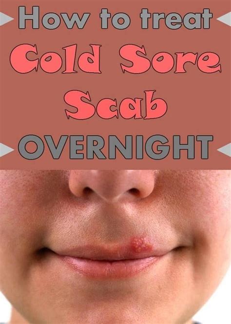 How to Get Rid of a Scab? | Cold sore scab, Cold sores remedies, Cold sore