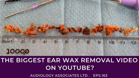 Biggest earwax removal ever? – Self Reliance Central