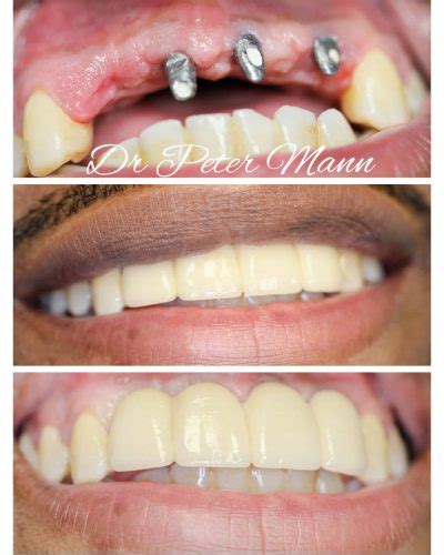 Dental Implants before and after photo | Manhattan | Dentist