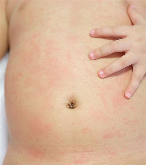 Causes Of Roseola In Toddlers, Signs, Treatment & Prevention