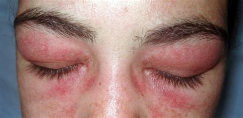 heliotrope rash | teesneuro.org