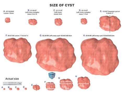 Size of Ovarian Cyst - TrialQuest Inc.