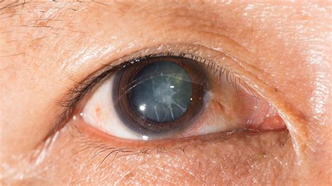 What Is a Cortical Cataract? Symptoms, Causes, and Treatment