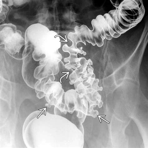 Colonic Diverticulosis | Radiology Key