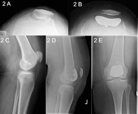 Patellofemoral joint (PFJ) arthritis. A. Skyline X-Ray showing PFJ... | Download Scientific Diagram