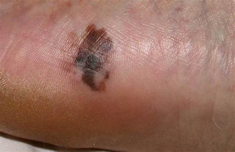 Acral Lentiginous Melanoma Metastatic Melanoma