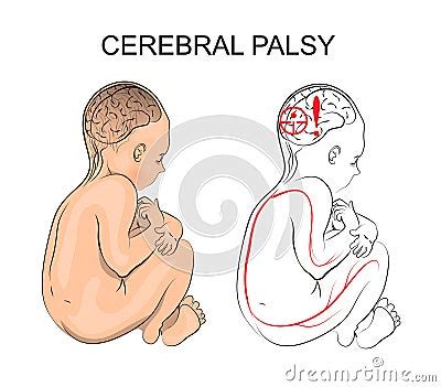 Cerebral Palsy. Neurology Cartoon Vector | CartoonDealer.com #64514663