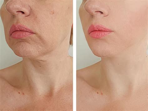 Neck Lift Recovery: The Do's and Don'ts | Miami, FL