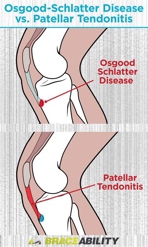 Osgood Schlatter Disease | Treatment, Exercises & Surgery