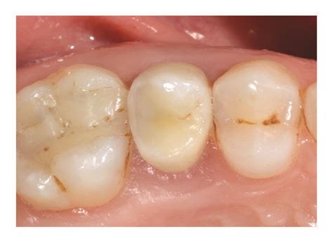 Delayed implant placement of a maxillary second premolar (#15).... | Download Scientific Diagram