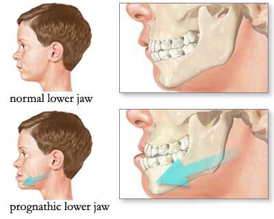 Pin on Jaw