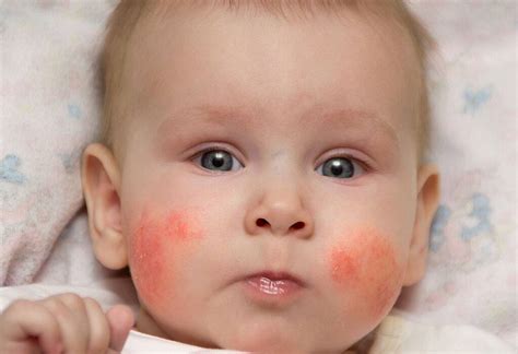 Stork Bite vs Hemangioma - Baby Rashes