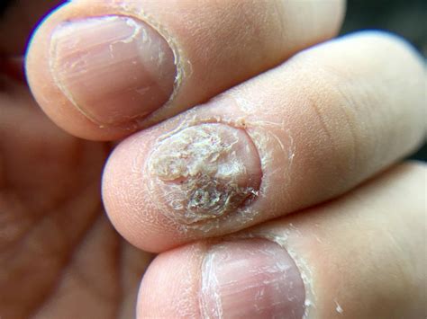 Hand Nail Fungus