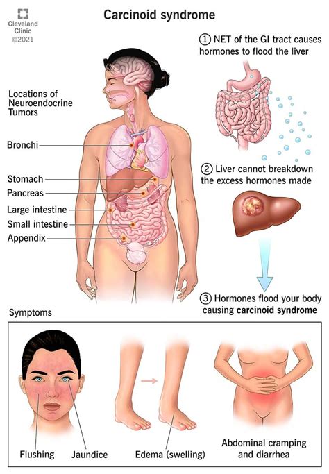 Managing Carcinoid Syndrome: Tips And Strategies - Ask The Nurse Expert