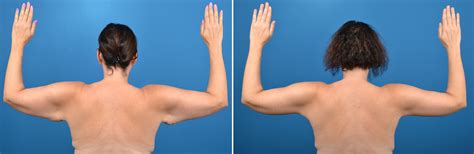 Brachioplasty (Arm Lift) Surgery in Florida