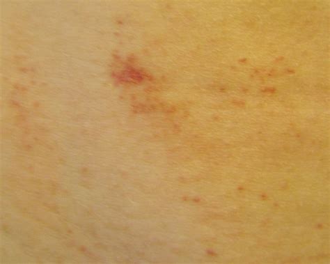 Small Red Spots On Skin Petechiae