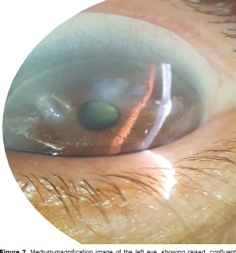 Figure 1 from Peripheral hypertrophic subepithelial corneal ...