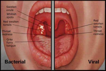 Bacterial vs. Viral Sore Throat | Treatment for sore throat, Throat infection, Strep throat