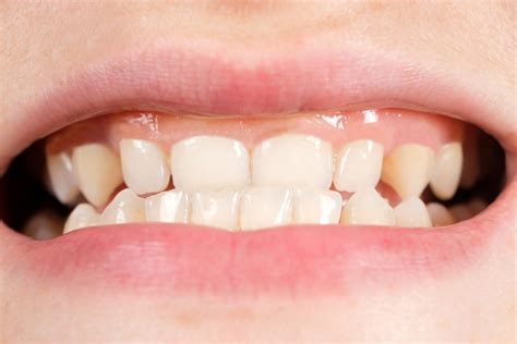 Gingival hyperplasia - Dentist in Newbury Park