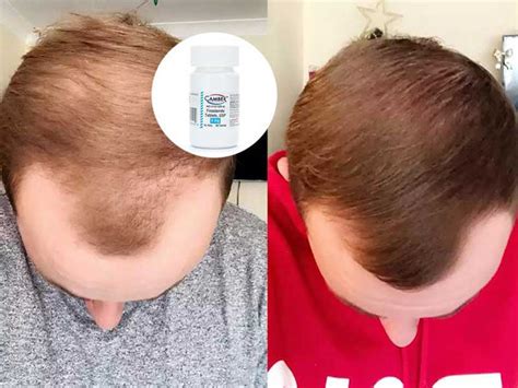 15+ Trt And Hair Loss - ElizabethAbbi