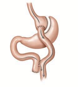 Roux-en-Y Gastric Bypass Surgery | Northwestern Medicine