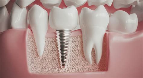 Am I Allergic to Titanium Dental Implants? | HealthNews